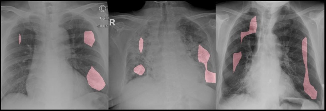 COVID-NET example for computer vision to detect shadows in lung tissue