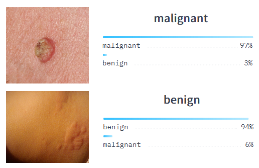 Example of malignant/benign classification with Computer Vision