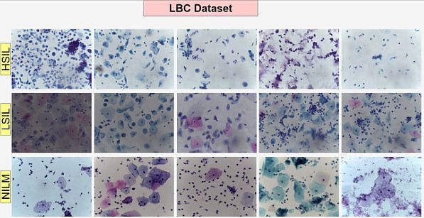 Cervical Cancer detection on LBC datasets 