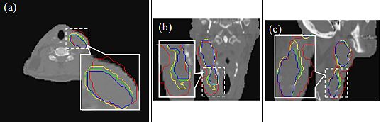 Contour-based image registration from multiple CT scans (contours marked manually) 