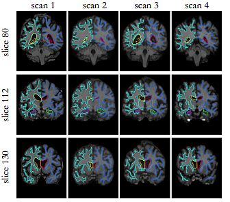 Image Registration by Multiple MRI Brain Scans with affine transformation alignment 